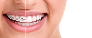 a person receiving dental braces tx 