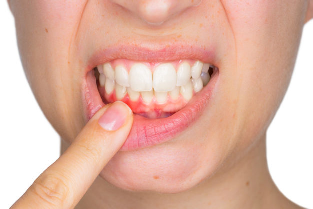 woman asking how to prevent tooth decay