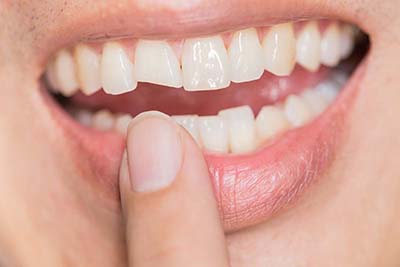 Treatment for Cracked Teeth individual pointing to show they need Treatment for Cracked Teeth