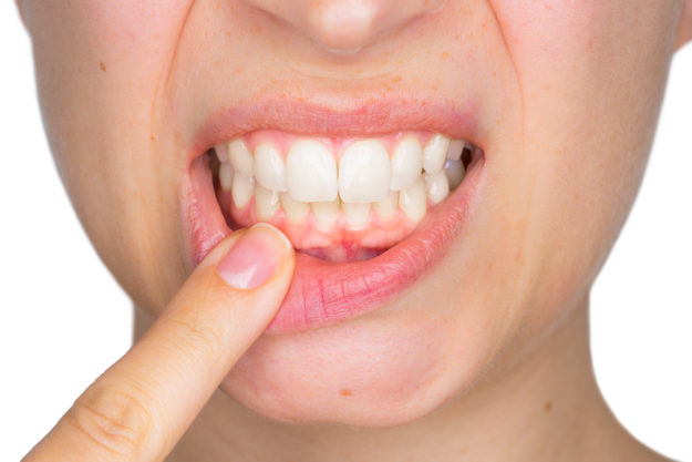 a woman asking about the causes of receding gums