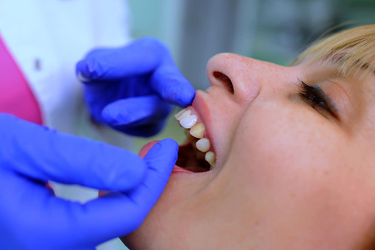 a patient getting dental veneers