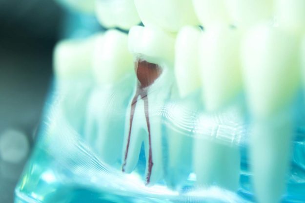 an illustration of a root canal
