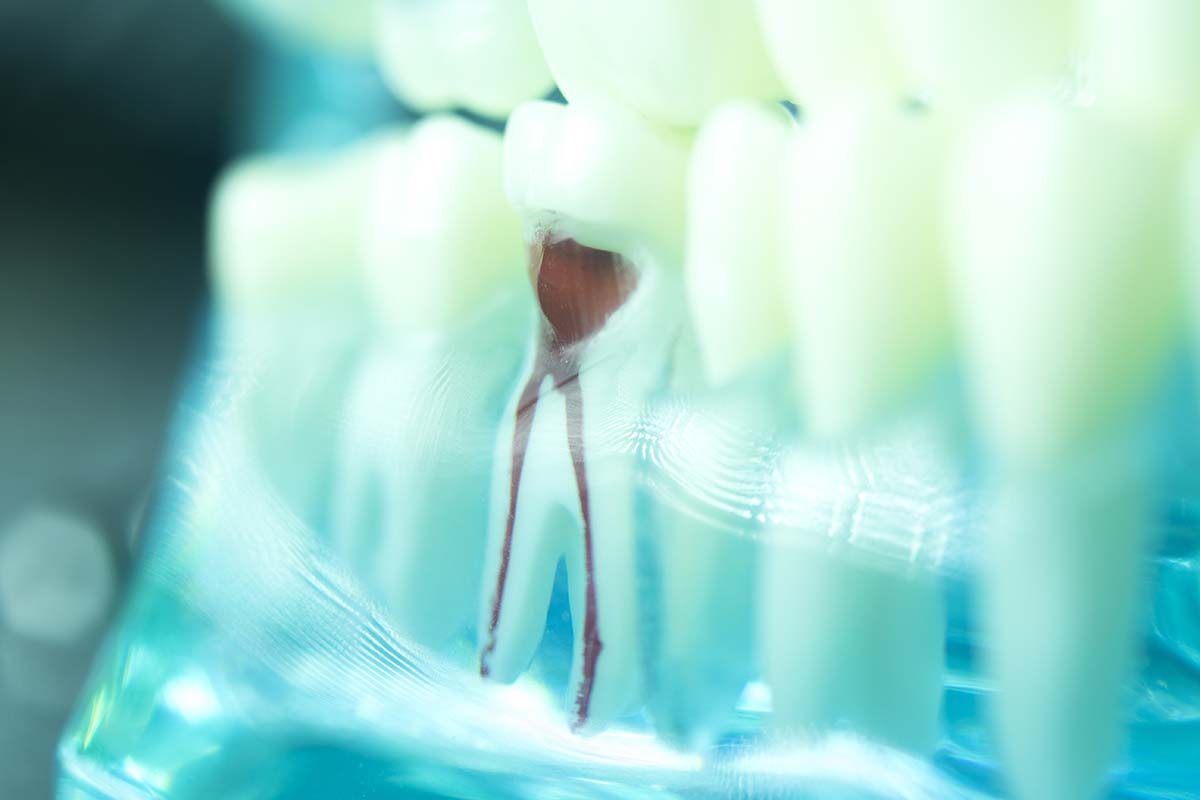 an illustration of a root canal