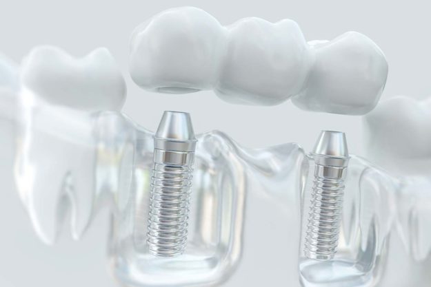 a model of different types of dental implants