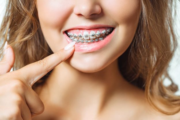 a young woman with adult braces
