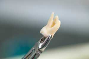 a tooth after Tooth extraction