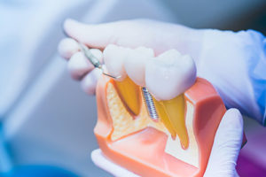 a dentist explains how dental implants work