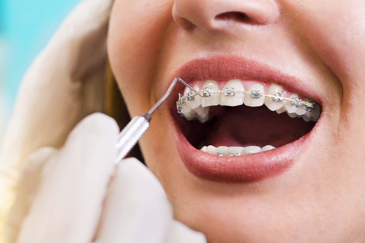 3 Benefits of Adult Orthodontic Services (3) woman getting adult orthodontics
