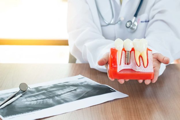 4 Benefits of Dental Implants (1) doctor explains dental implants