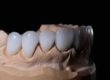 example of dental veneers