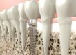 example of dental implants