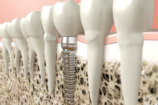 How Do Dental Implants Work (1) example of dental implants