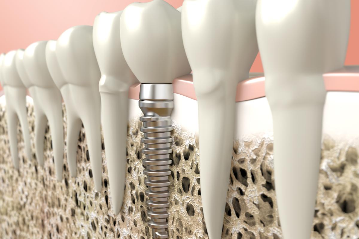 example of dental implants